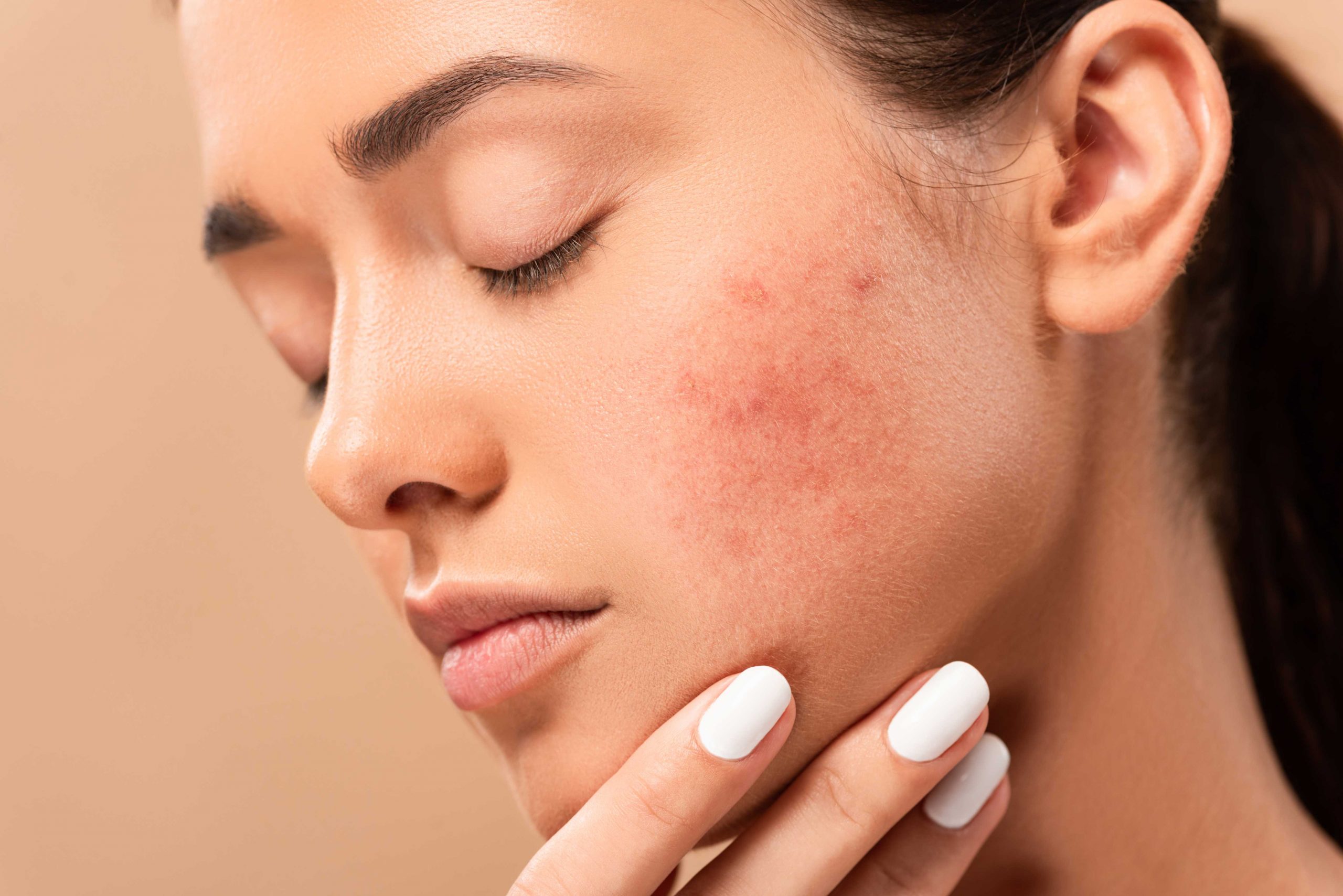 acne scars can affect more than just your skin
