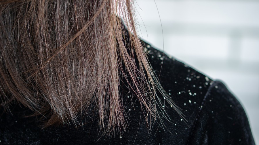 all about dandruff